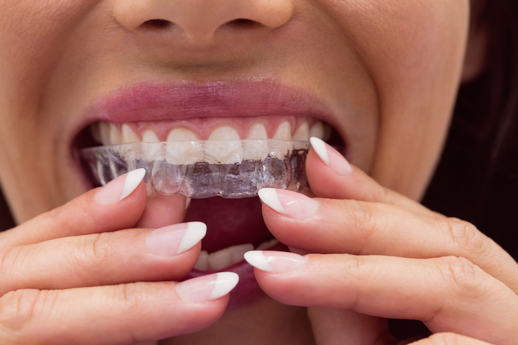 transforma-sonrisa-invisalign-jerez-precision-confort-1