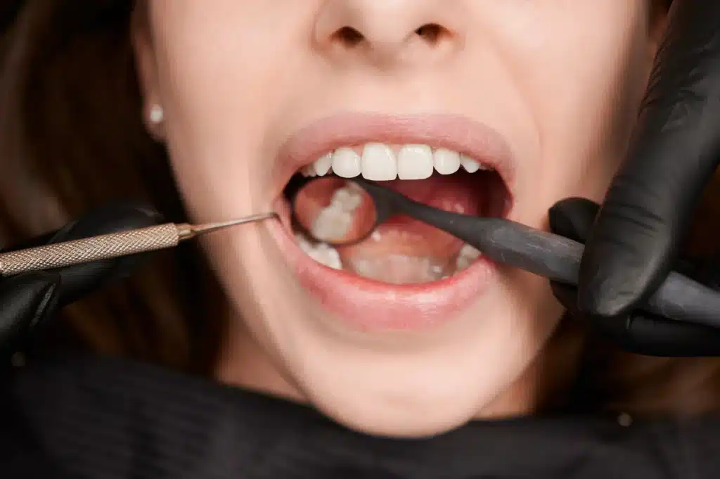 caries dentales