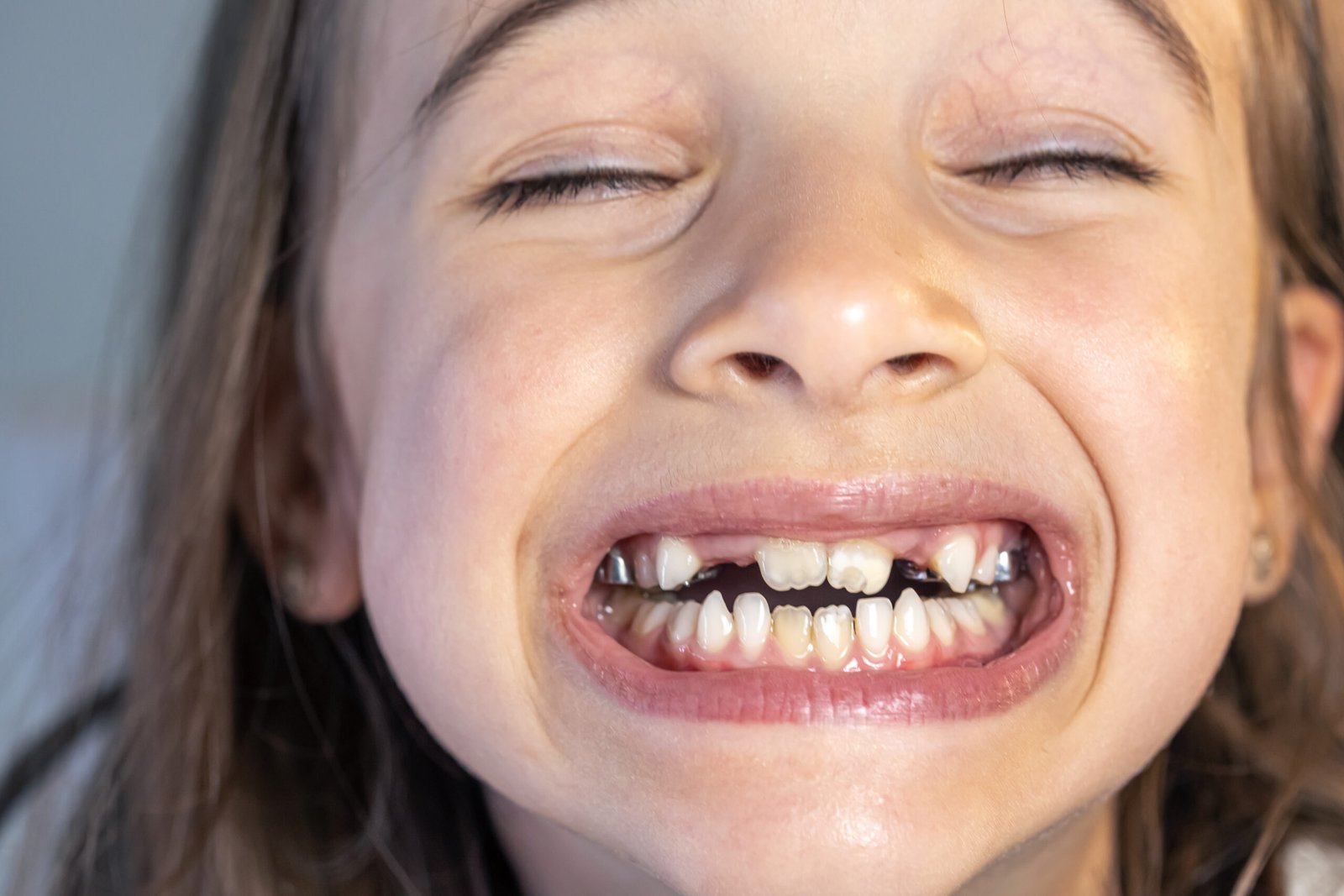 ¿A qué edad se pueden poner carillas dentales