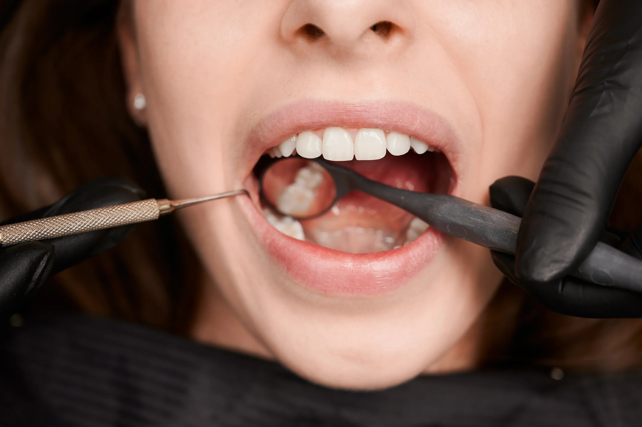 Empaste vs endodoncia